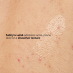 close-up of skin with The Ordinary Salicylic Acid 0.5% Body Serum swatch applied