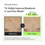 before and after comparision of skin with improved breakouts