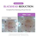 before and after comparision of blackhead reduction 
