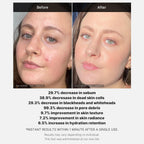 medicube Red Acne Succinic Acid Peel 40g (1.41 oz) MediCube